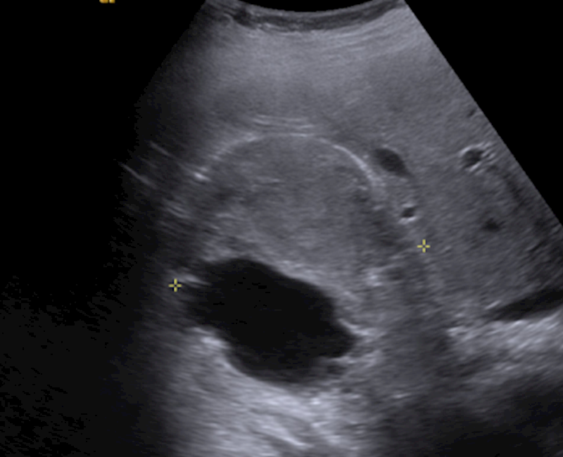 Chromophobe renal cell carcinoma: An unexpected finding in a pelvic ultrasound